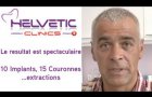 10 Implants dentaires